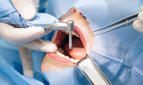 Implant Treatment